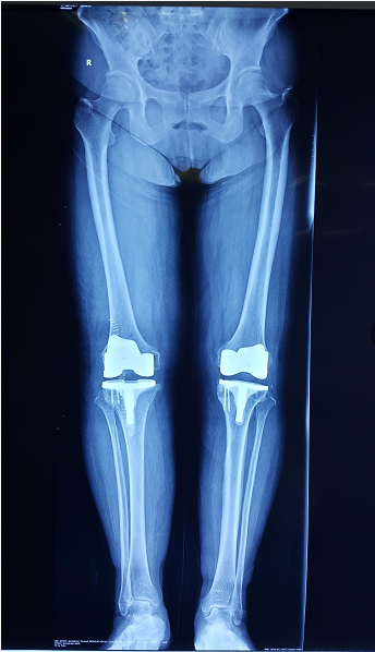 我院骨外科为"吹风膝"患者成功实施膝关节表面置换术